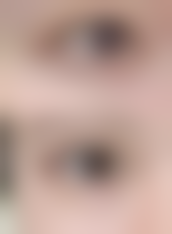 南通星灿整形医院真实实例：亲眼见证美丽蜕变