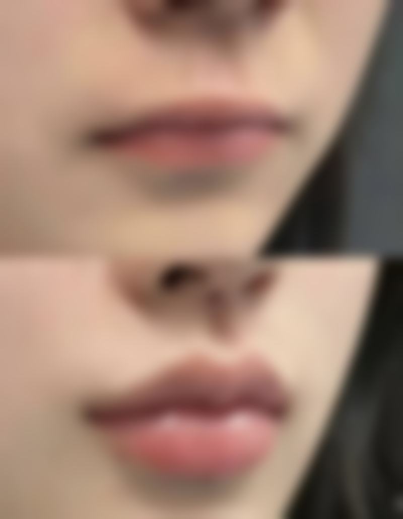 武科 大附属紫荆医院做双眼皮后遗症重度吗