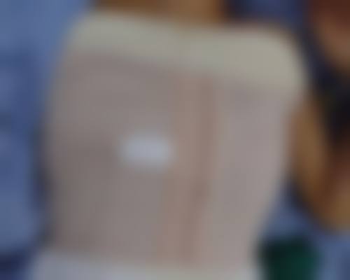 双眼皮割了有后遗症吗？揭秘3大常见误解，掌握5个关键要点让你安心变美！ 