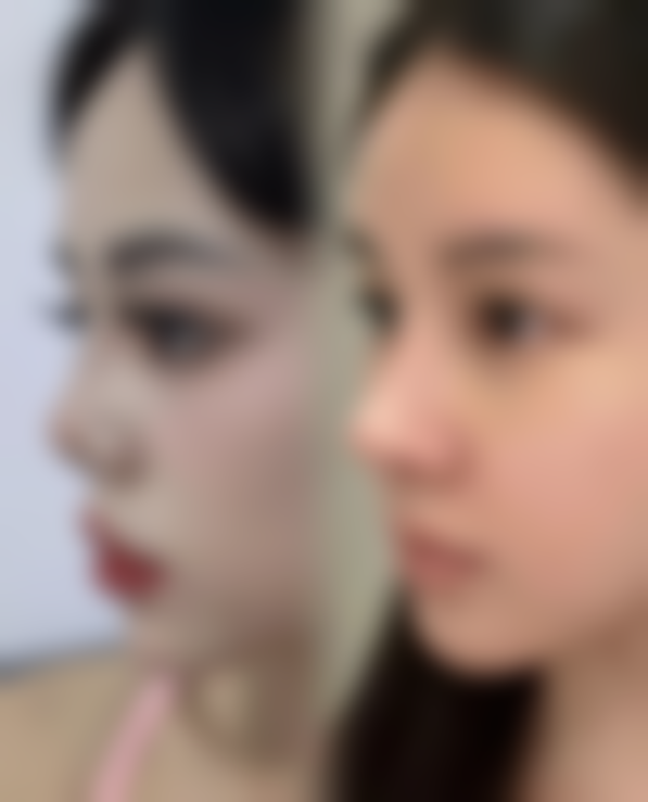 北京东方百合整形医院真实实例