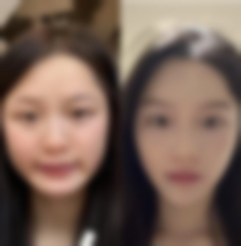 北京圣嘉新医疗美容医院割双眼皮成效怎么样？