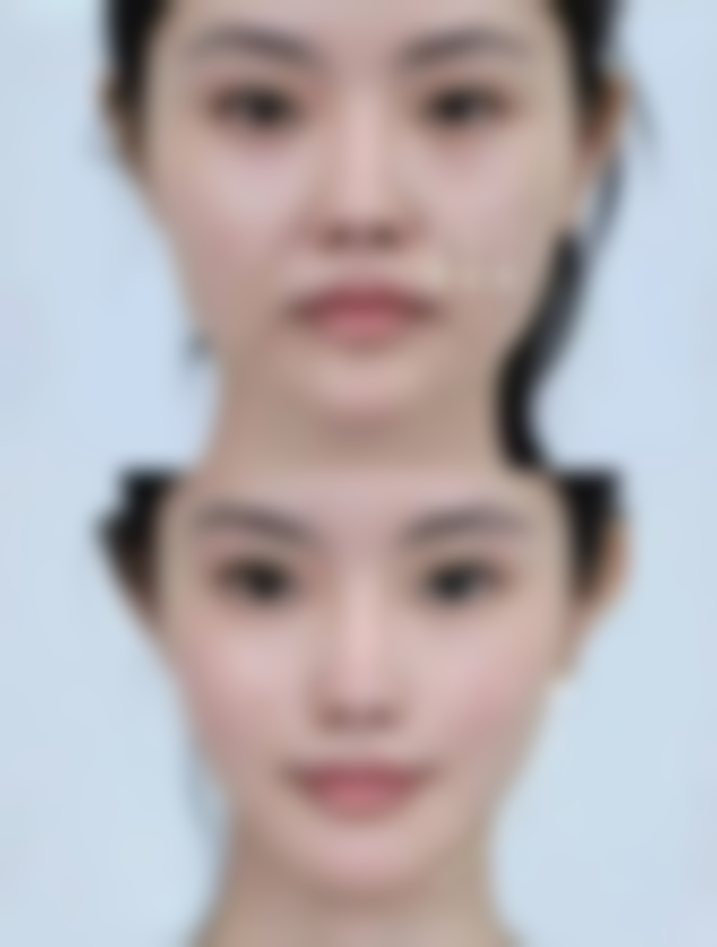 北京画美医疗美容割双眼皮时神经保护怎么样?