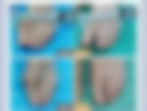 伤口的疤痕凸起来了怎么办？别慌！揭秘医美界3大有效祛疤方法，还你光滑无瑕肌肤！ 