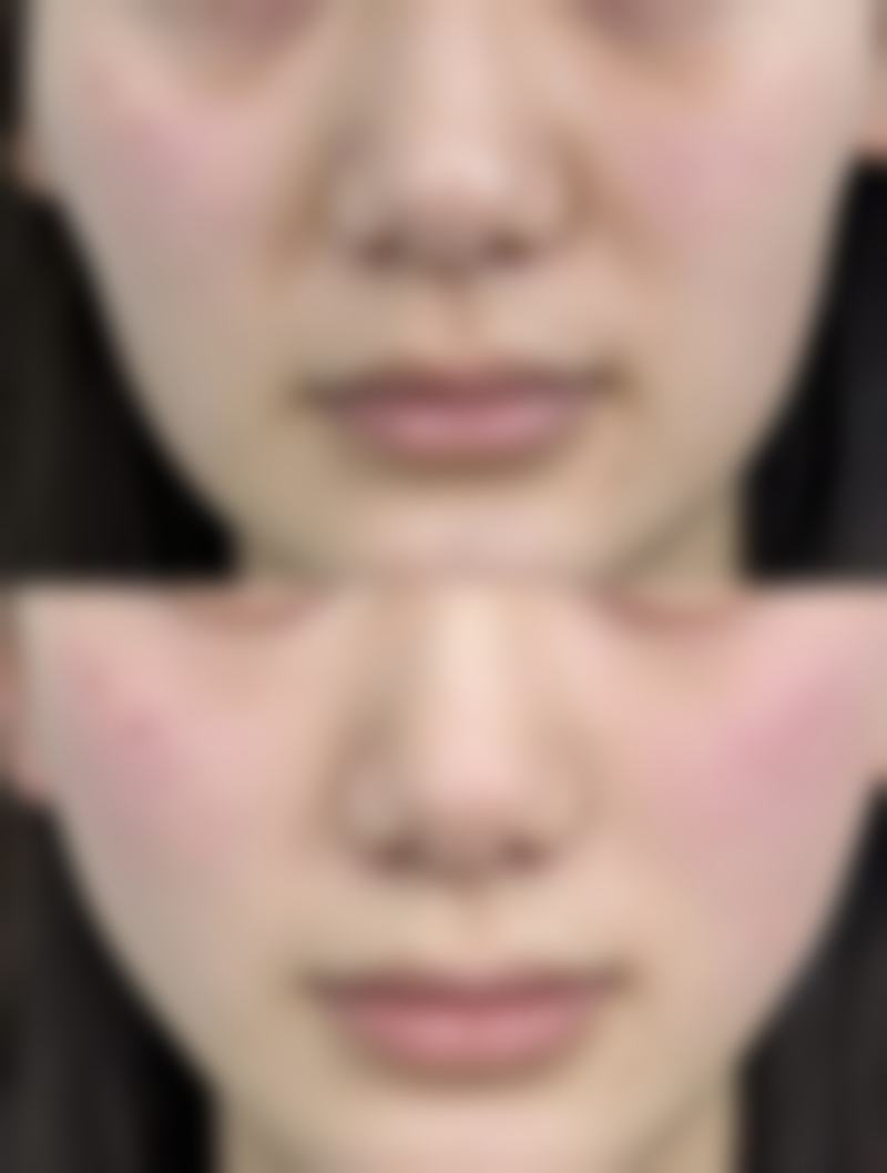 崔贤敏（Choi Hyun - min）院长技术特点：精良与创新并存