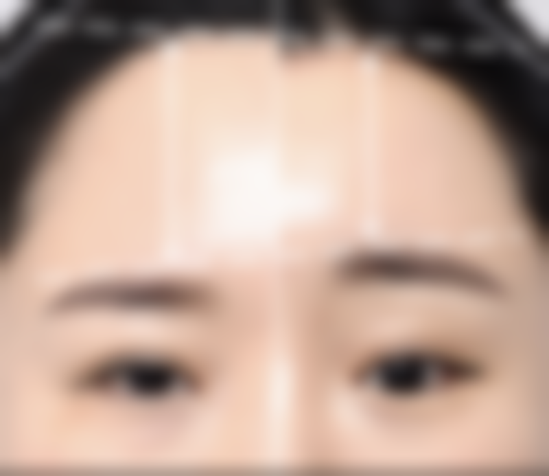 激光祛疤修复伤口凸起疤痕靠谱吗？