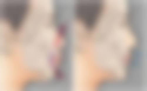 三亚西尔维娅医疗美容医院去除咬伤疤痕好不好？