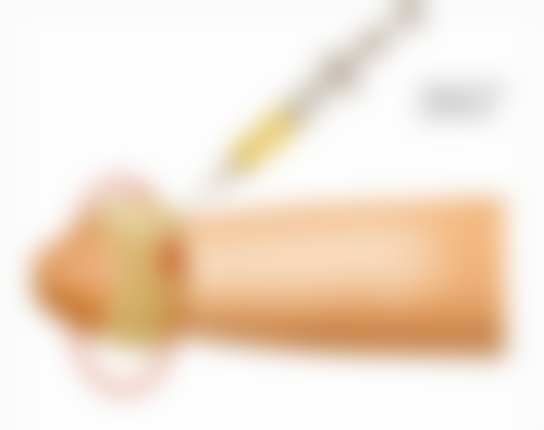 北京圣嘉新医疗美容医院割双眼皮后经常玩手机会增加感染几率吗？