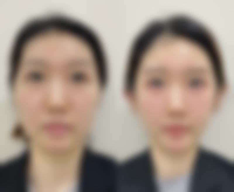 北京嘉禾医疗美容去掉眼袋和黑眼圈适合吗？