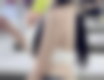 双眼皮手术过程要多久？平均30 - 60分钟！揭秘不同术式时间差异及快速恢复小妙招，你知道吗？ 