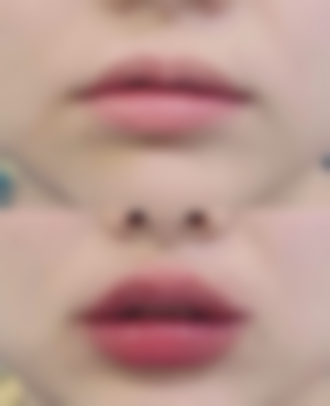 北京嘉禾医疗美容割双眼皮后碰水了修复成效怎么样