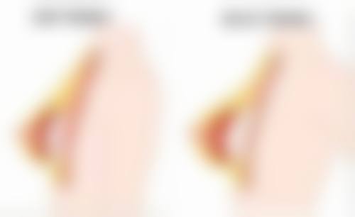 北京加减美医疗美容打完除皱针皮肤特别紧绷正常吗？