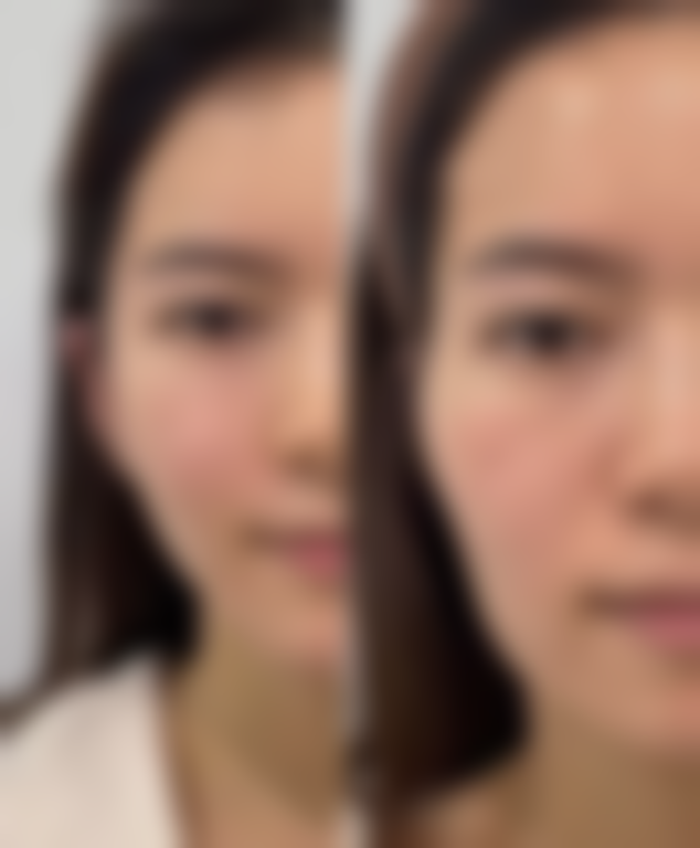 打完除皱针皮肤特别紧绷怎么办？掌握这5大应对妙招，轻松缓解紧绷感恢复肌肤舒适状态！ 