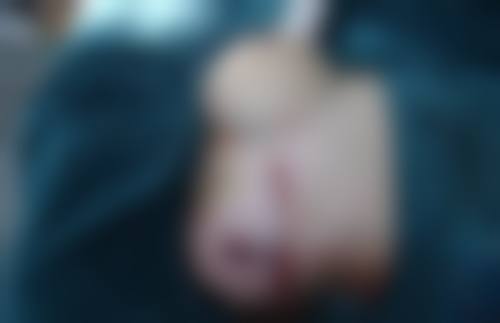 点阵激光修复坑疤痕适合吗？