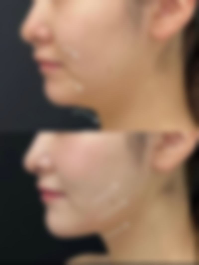 割完双眼皮可以吃金针菇吗？权威解答：金针菇营养丰富，术后食用好处多，助你快速恢复美丽双眸！ 