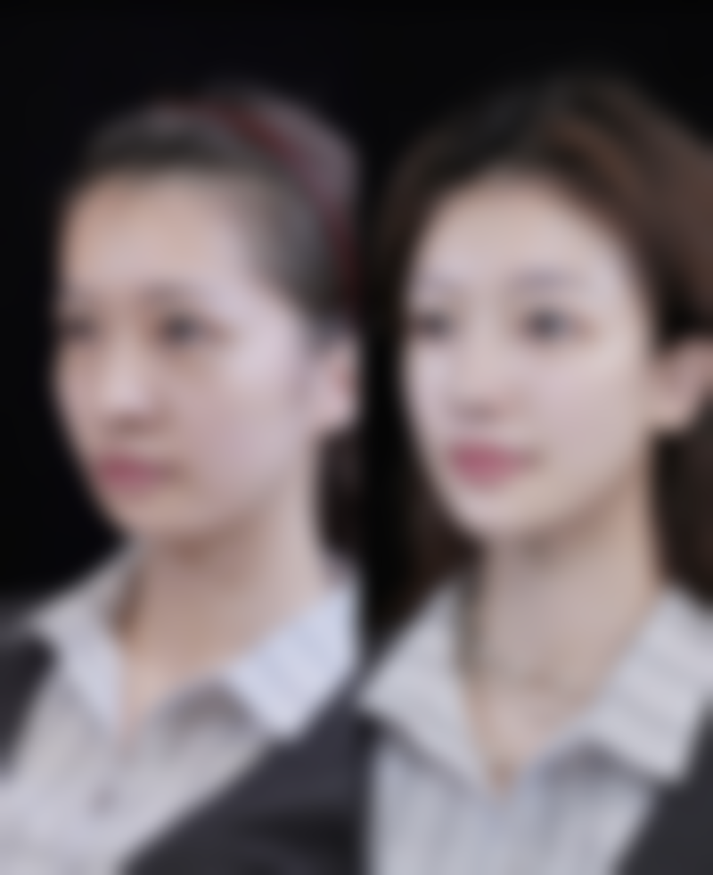 北京嘉禾医疗美容去眼袋后眼睛凹陷修复正常值不值