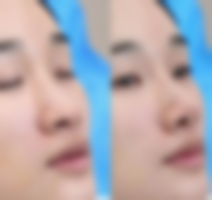 东莞凤岗天天美整形医院真实实例