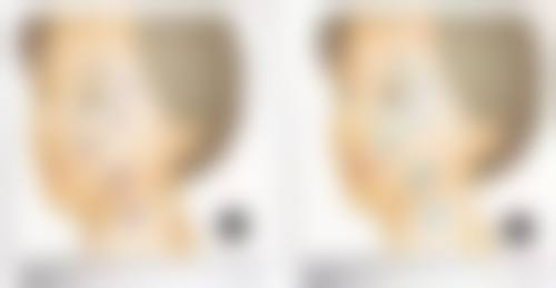 荆州汇美医疗美容修复双眼皮没割好值不值？