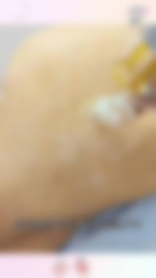 合肥蝶之星整形医院真实实例