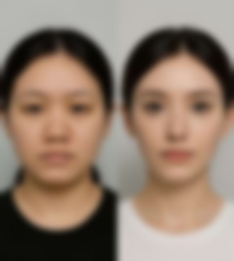 长沙雅美医疗美容医院割双眼皮的方法怎么样