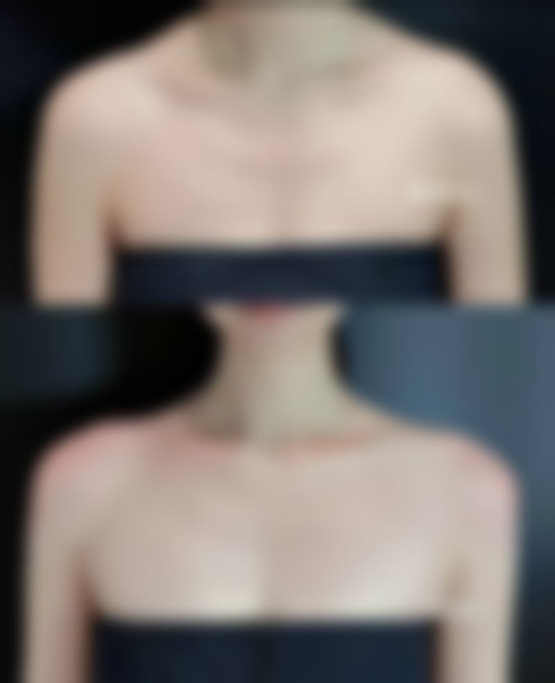 三亚微笑口腔医院去掉疤痕红印适合吗？