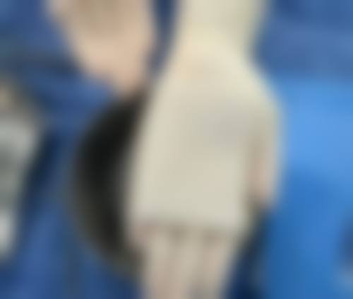 广州新市医院去除泪沟眼袋怎么样？