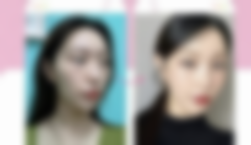 泪沟眼袋如何去除？揭秘医美界超火的填充与激光技术，让你轻松告别泪沟眼袋，恢复年轻光彩！ 