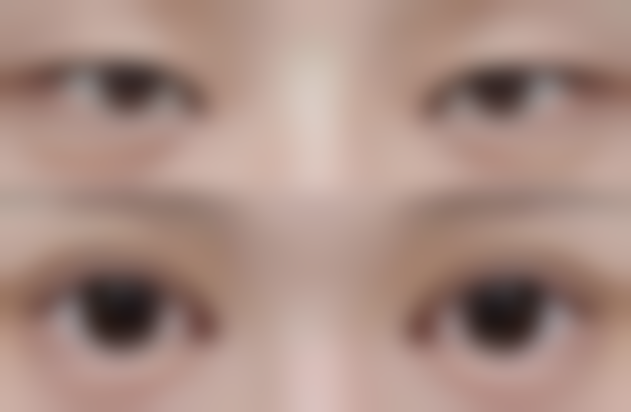 深圳健丽去泪沟眼袋靠谱吗？