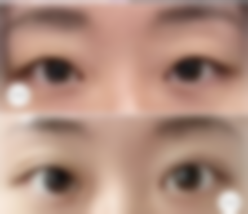 长沙美莱整形美容淡化缝针疤痕靠谱吗？