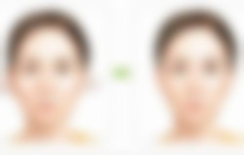 拉双眼皮多久能好，韩妃医美医院有保护吗？