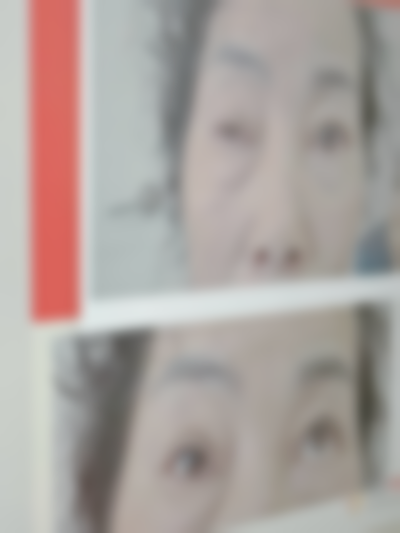 汕头汕美(华美)医疗美容医院真实实例:见证美丽蜕变