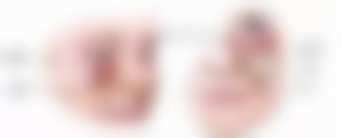 自体隆鼻恒久值不值