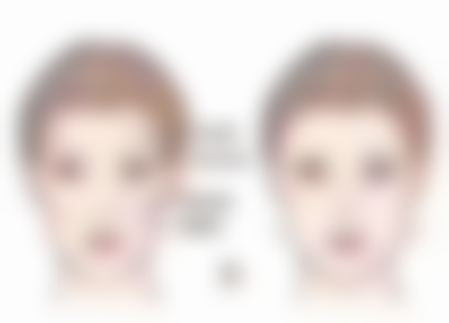 国字脸打瘦脸针后要注意什么