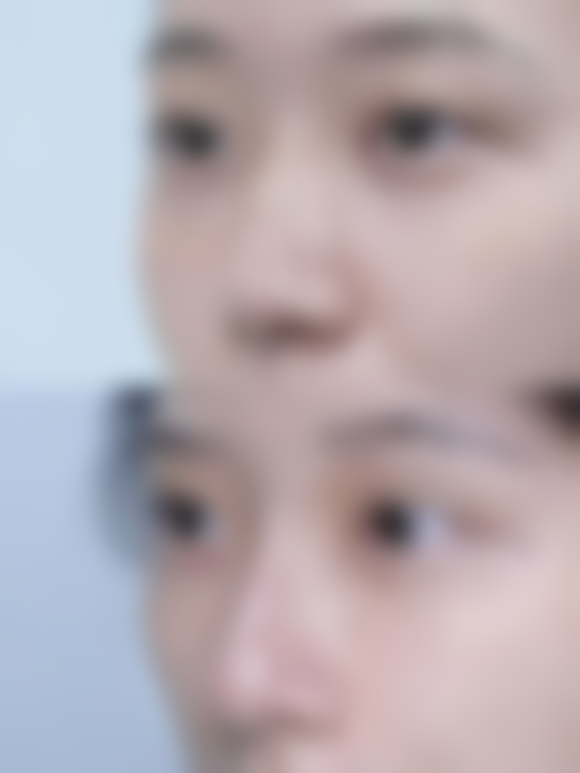 自体隆鼻恒久成效怎么样