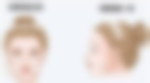 光子嫩肤改善疤痕增生在XX医美医院靠谱吗