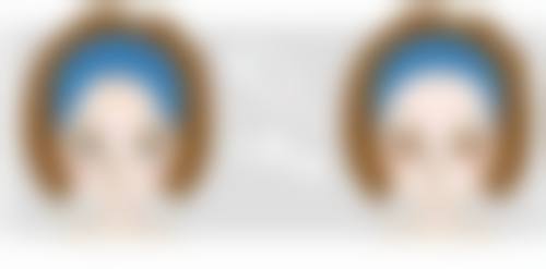 董文凤医生真实实例：见证美丽蜕变