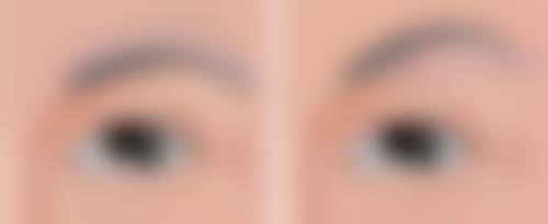 选择哪家医美医院治疗侧切疤痕增生好？