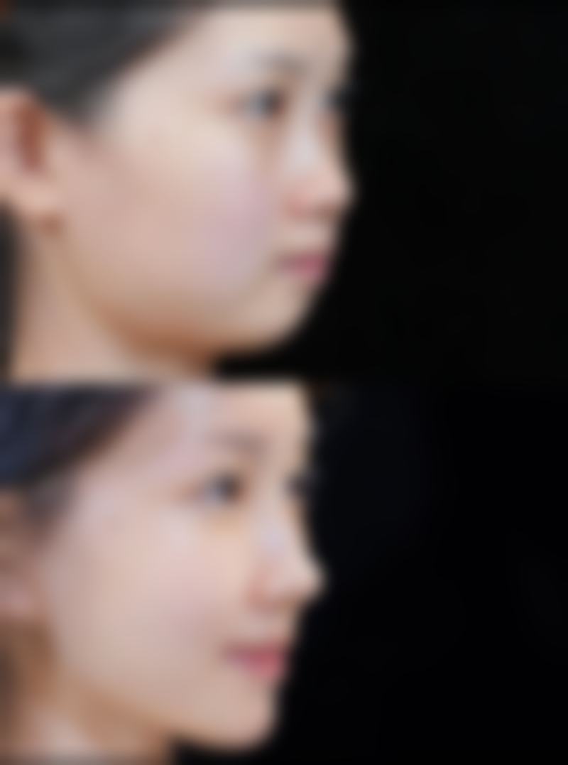 华美医美医院做双眼皮手术修复时间适合吗