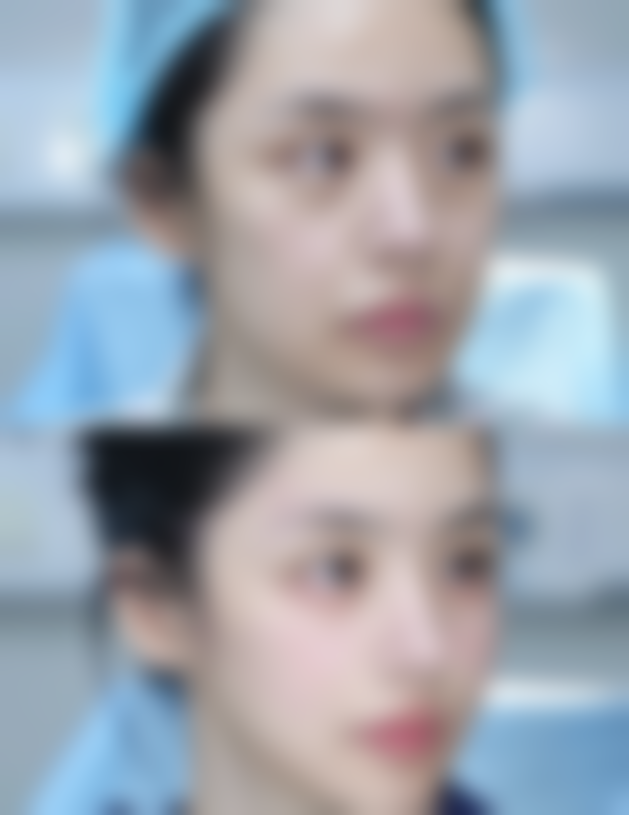 美莱医美医院做双眼皮手术修复时间怎么样