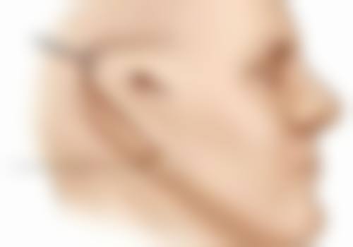 脸部疤痕可以美容吗？答案是肯定的！专业医美手段助你淡化疤痕，重焕光滑美肌！ 