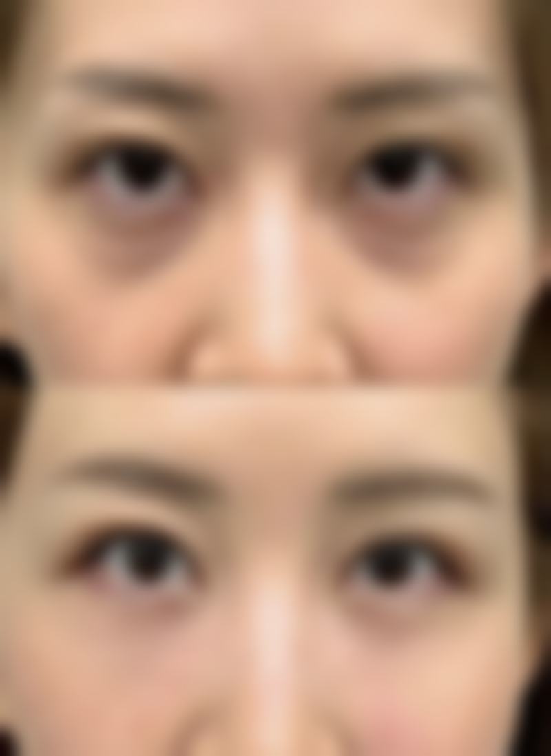 内切去眼袋怎么样，适合去除眼袋吗？