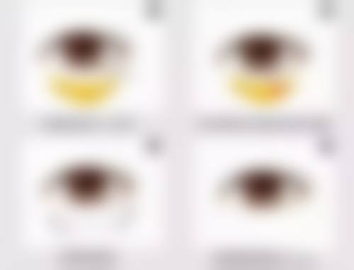 手术切除除顽固的眼袋适合吗