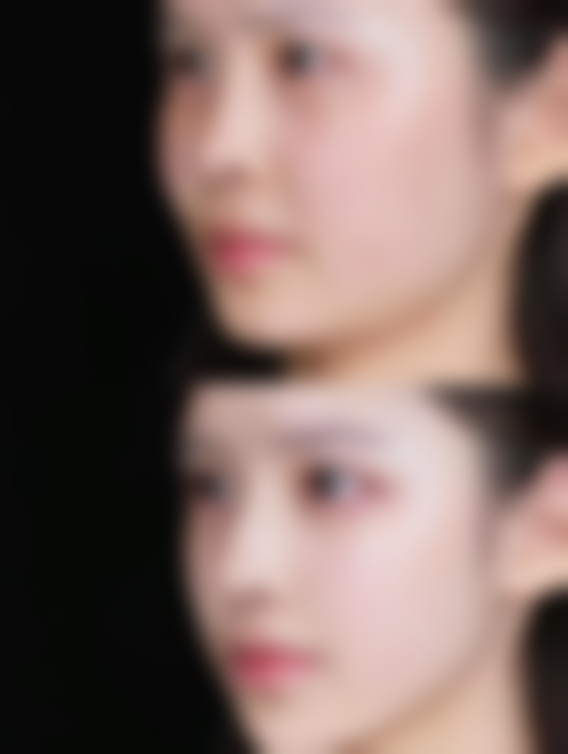 激光溶脂除顽固的眼袋靠谱吗