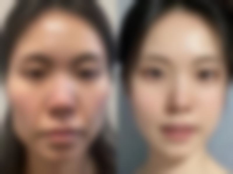 脸部吸脂肿胀期有哪些注意事项