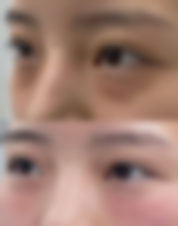 脸部吸脂肿胀期长正常吗