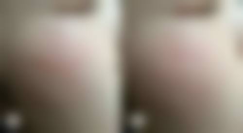 做双眼皮修复时间值不值关注