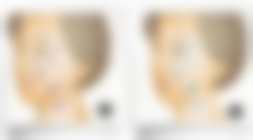 做双眼皮不同修复阶段的特点适合了解吗