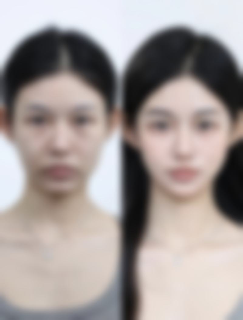 打了瘦脸针脸颊凹陷热敷真的能修复吗