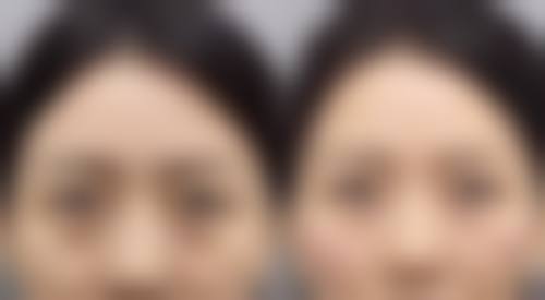 祛黑眼袋选择激光还是手术更值