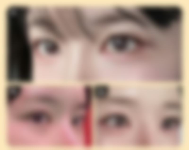 抽脂手术修复时间受哪些因素影响