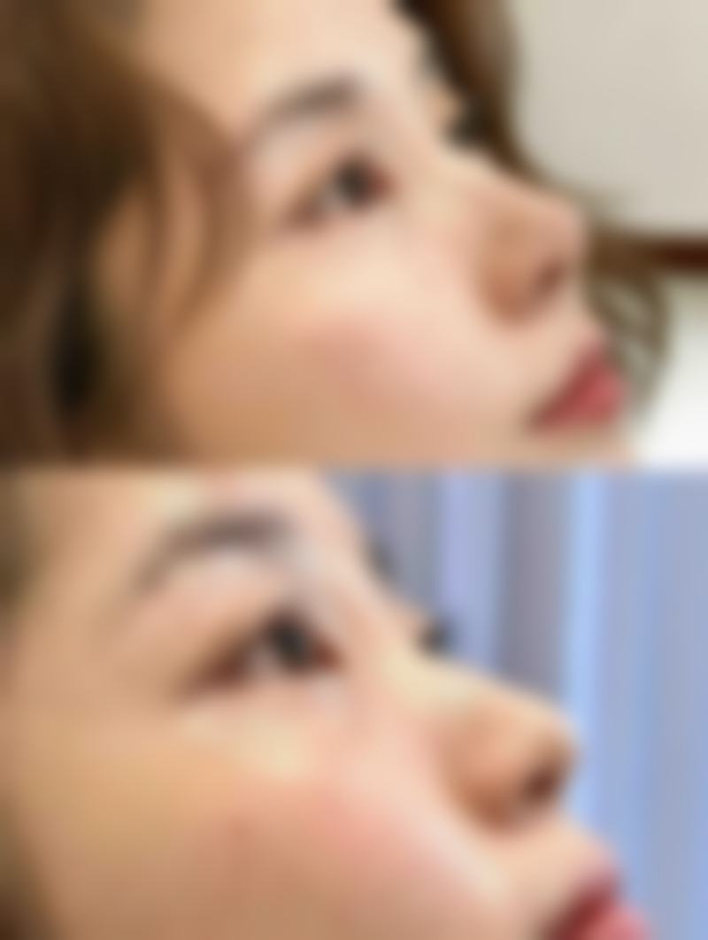 大部位抽脂修复需要更久靠谱吗